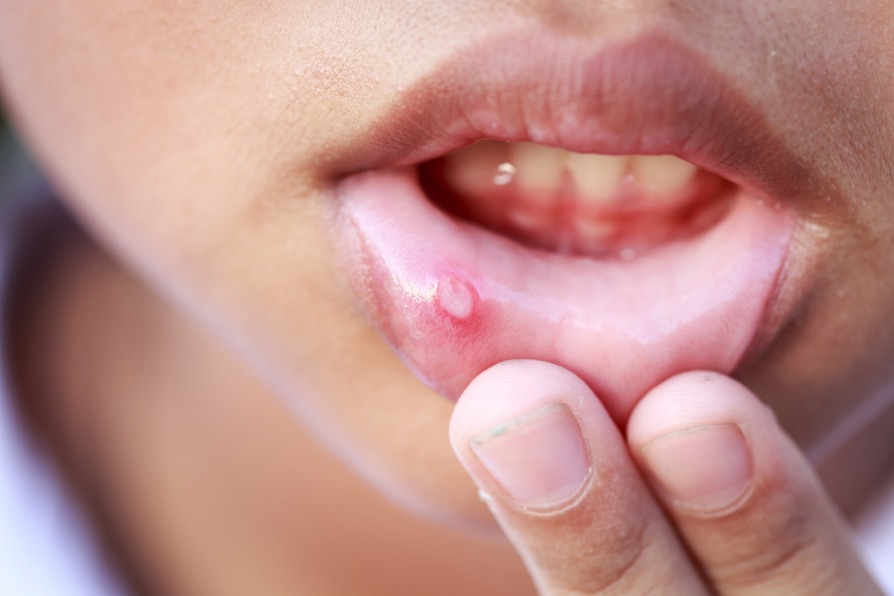 Mouth sores: Causes, treatment, and pictures